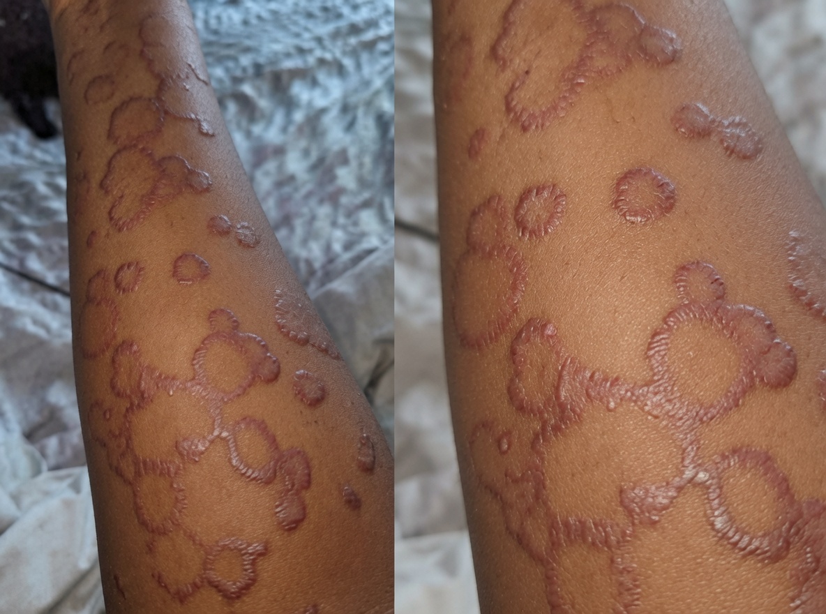 Tinea corporis: entenda o que é, como reconhecer e tratar